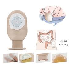 Colostomy Nursing Care